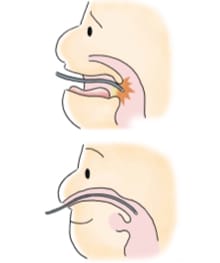 2. 嘔吐が起きにくい