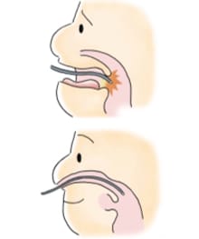 2.　嘔吐が起きにくい